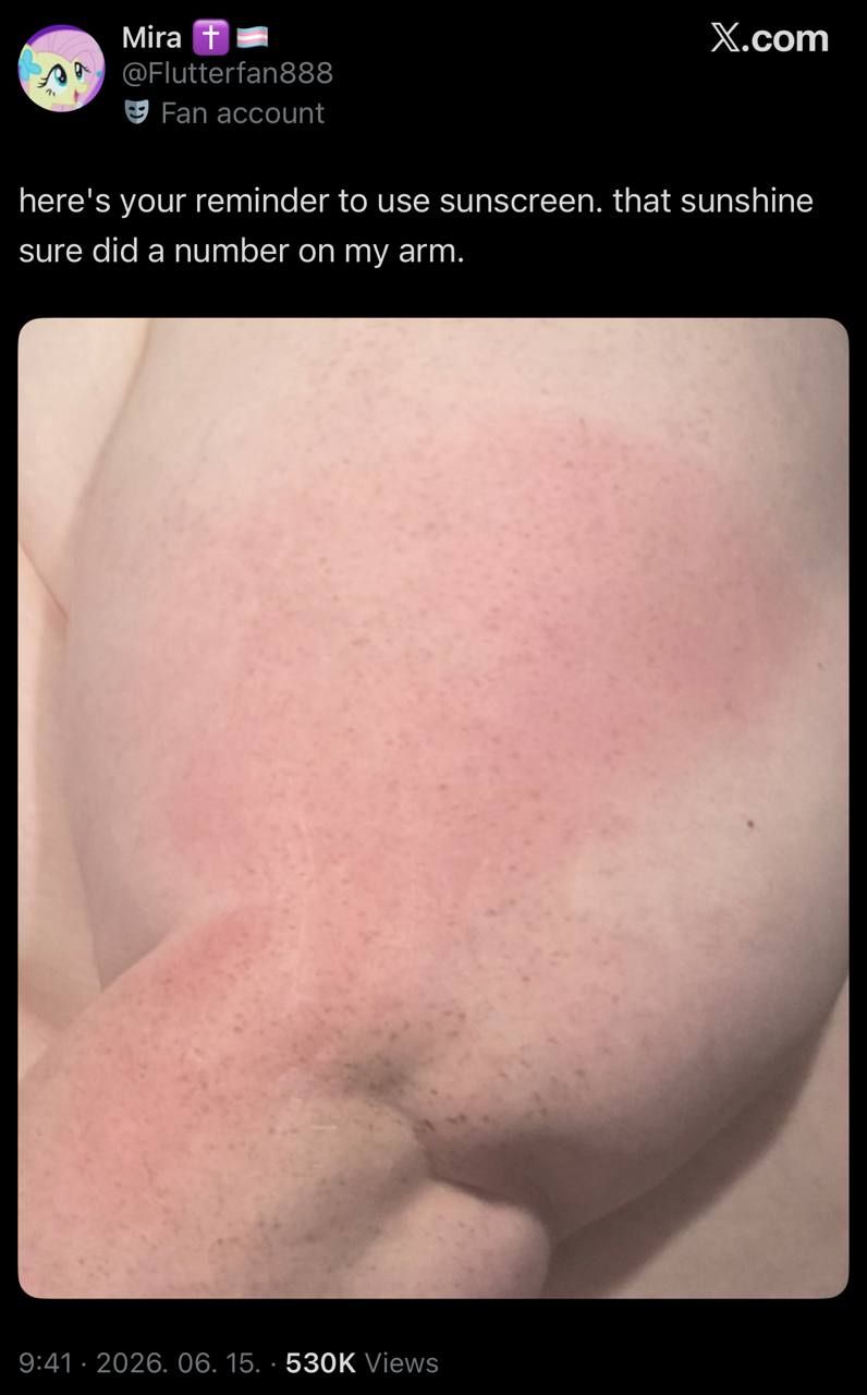 When you're so fat your sun burn shows timezones