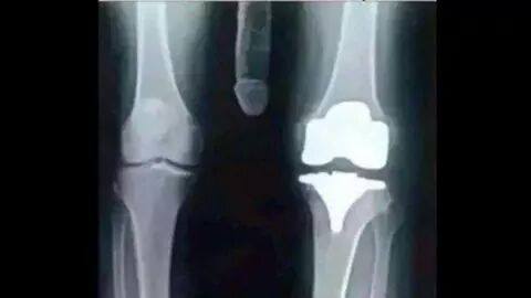 My knee was hurting, got it checked up today