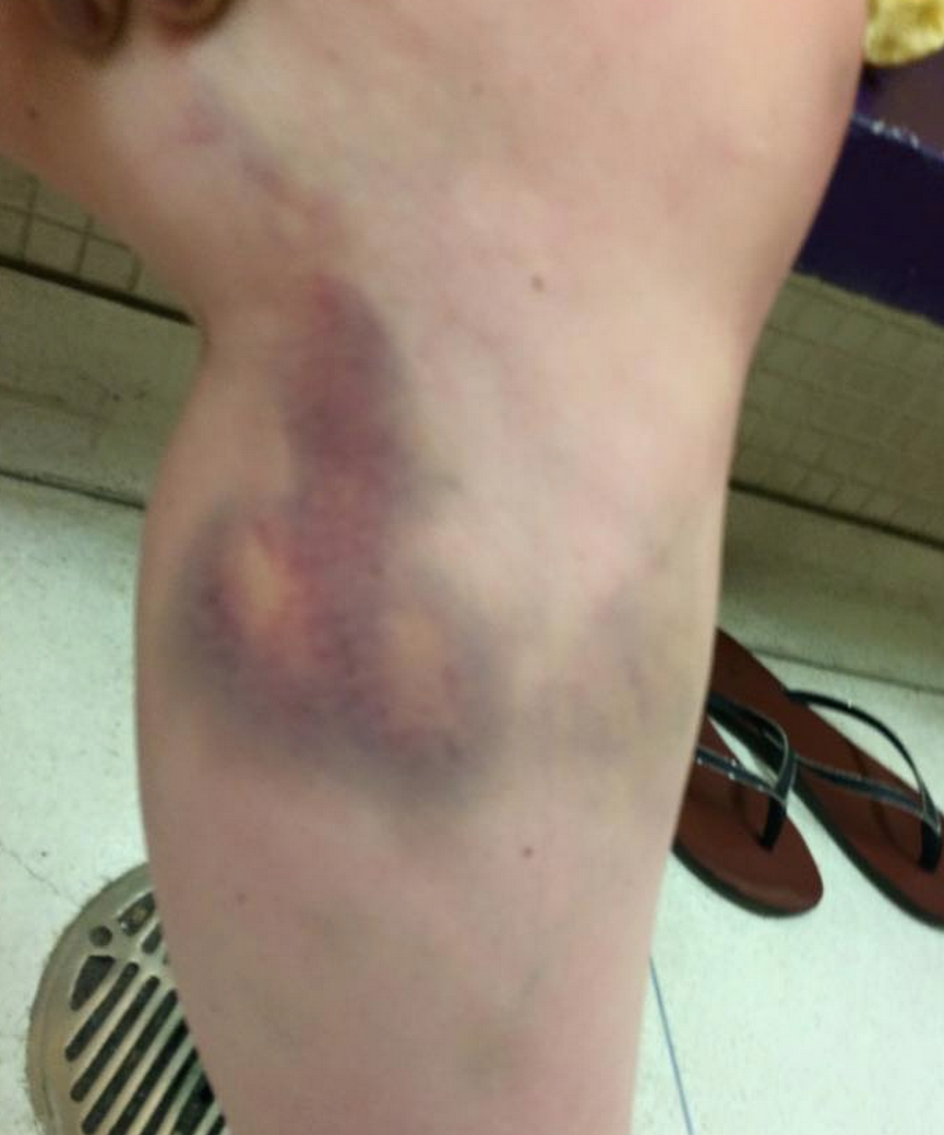 Got an ...interesting bruise today