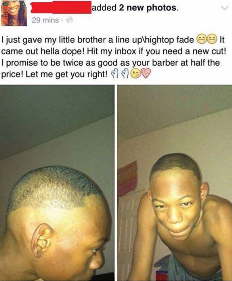 When you get your hairline done with the spoon