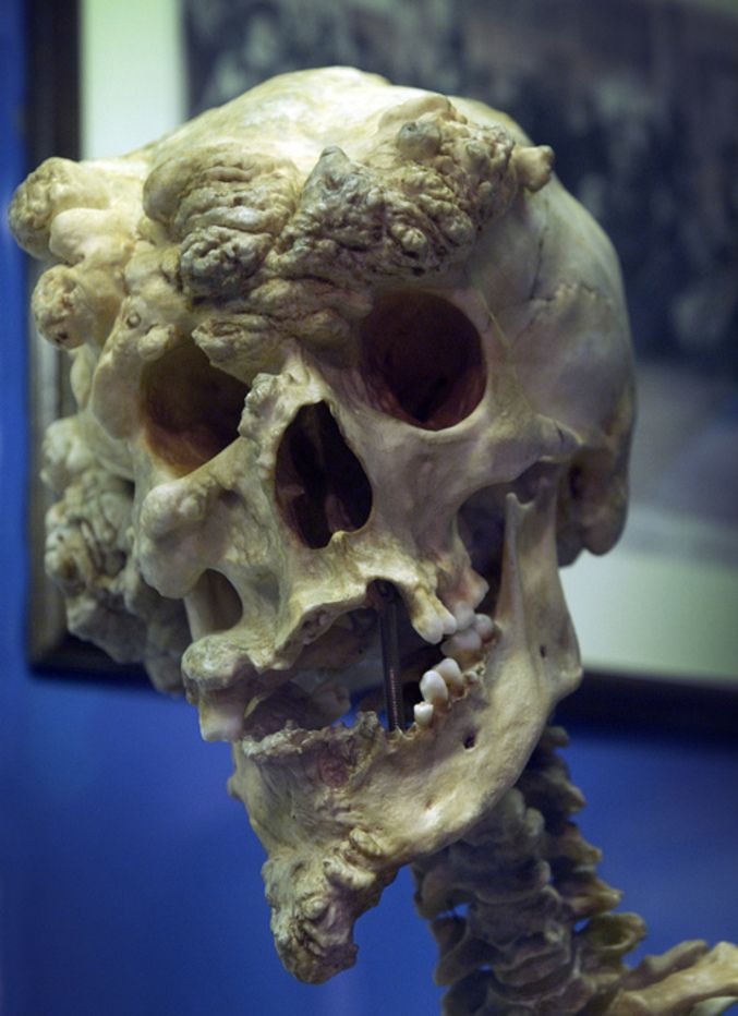 The skull of Joseph Merrick, often known as 'the elephant man'.