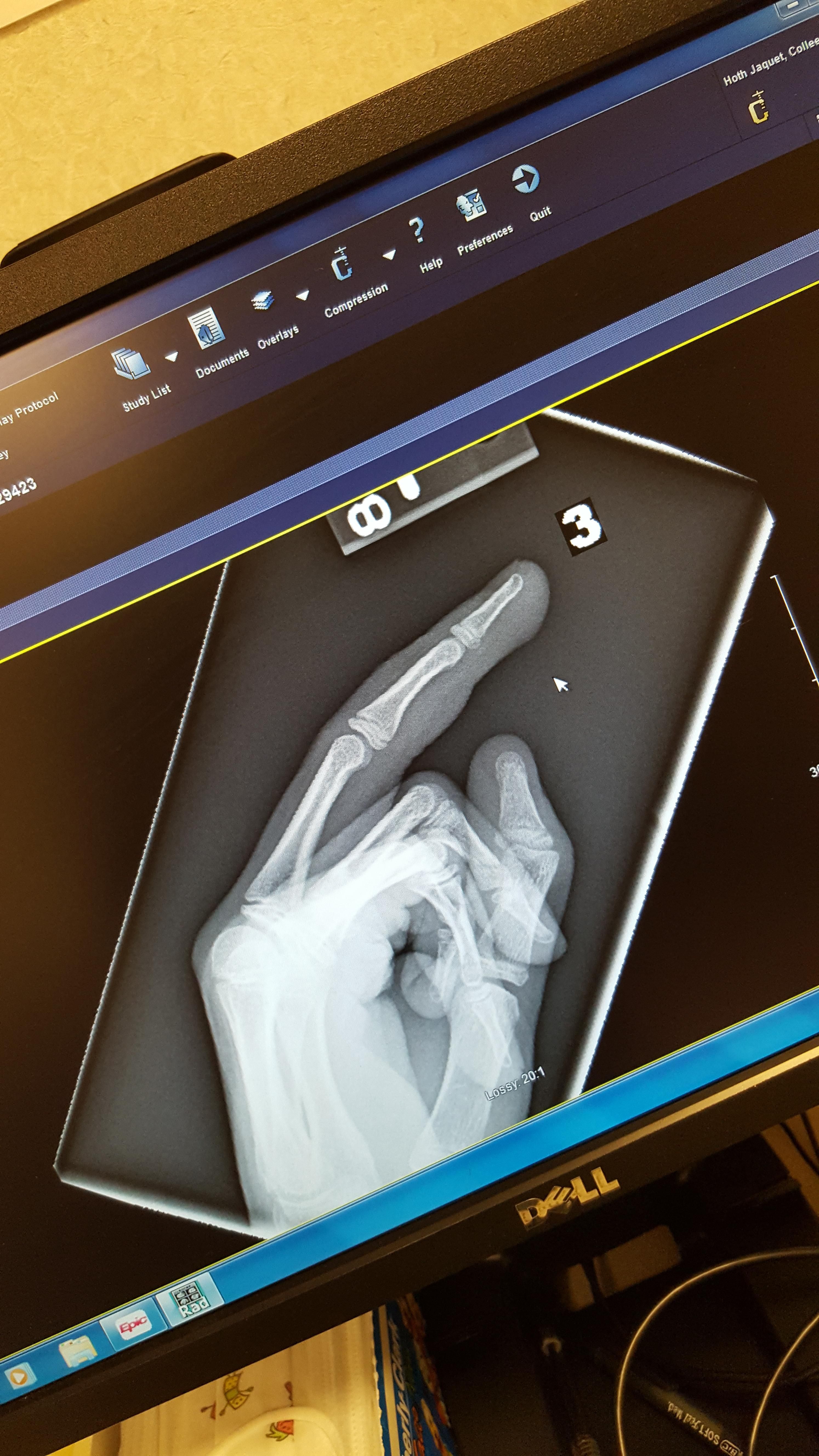 My 9 yr old daughter shut her middle finger in the car door, it's not broken, but the x-ray will live in infamy!