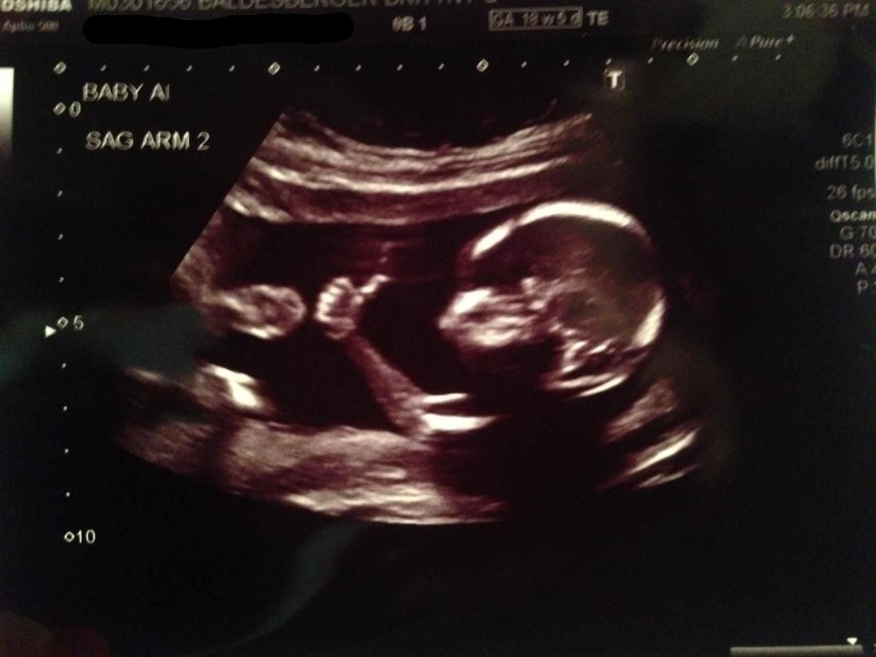 Recent ultrasound result looks good.