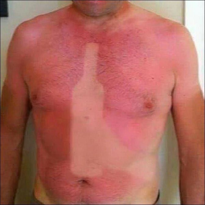 Came back from the beach with a bit of a sunburn.