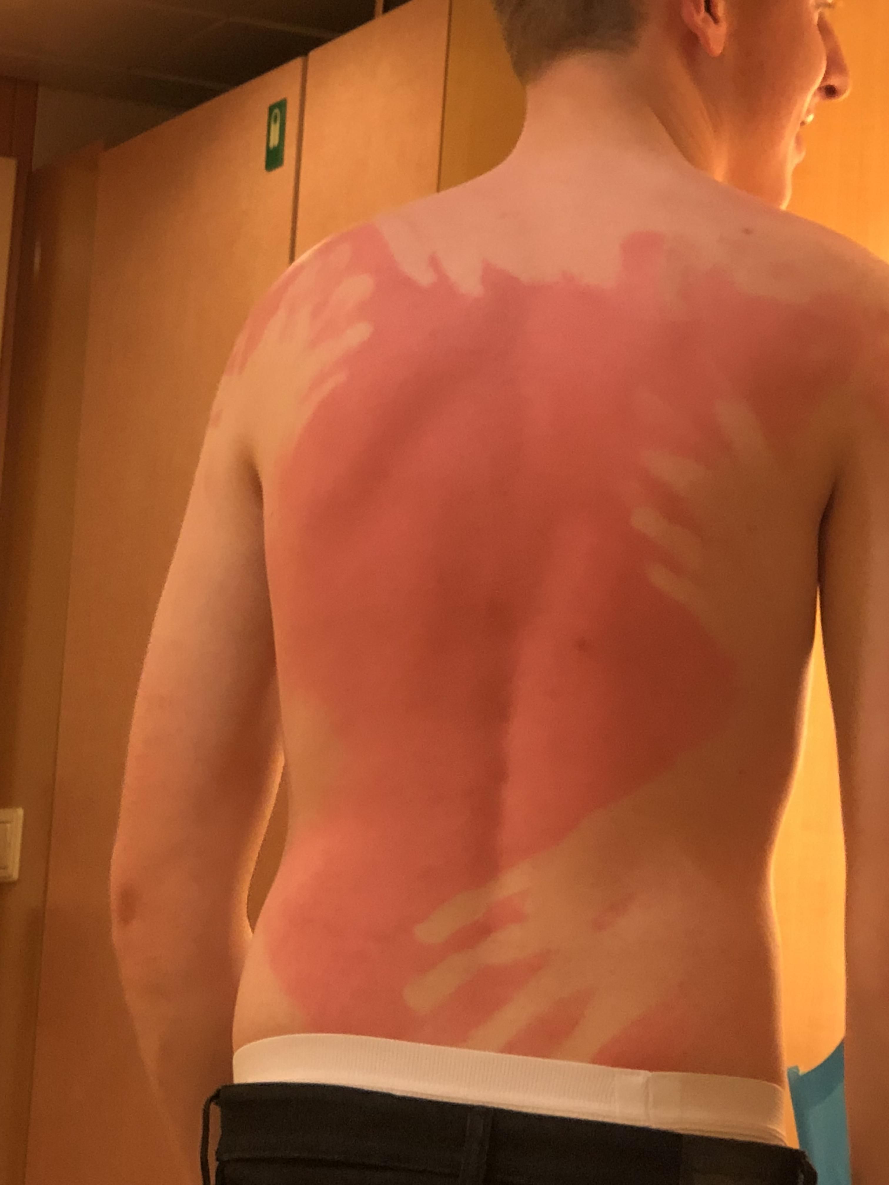 Sunscreen does actually work. Proof!