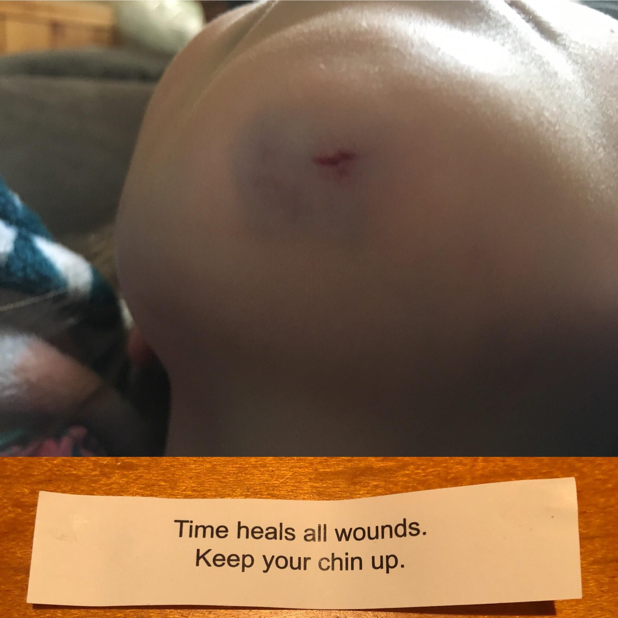 My daughter injured her chin today and at dinner received this fortune cookie.