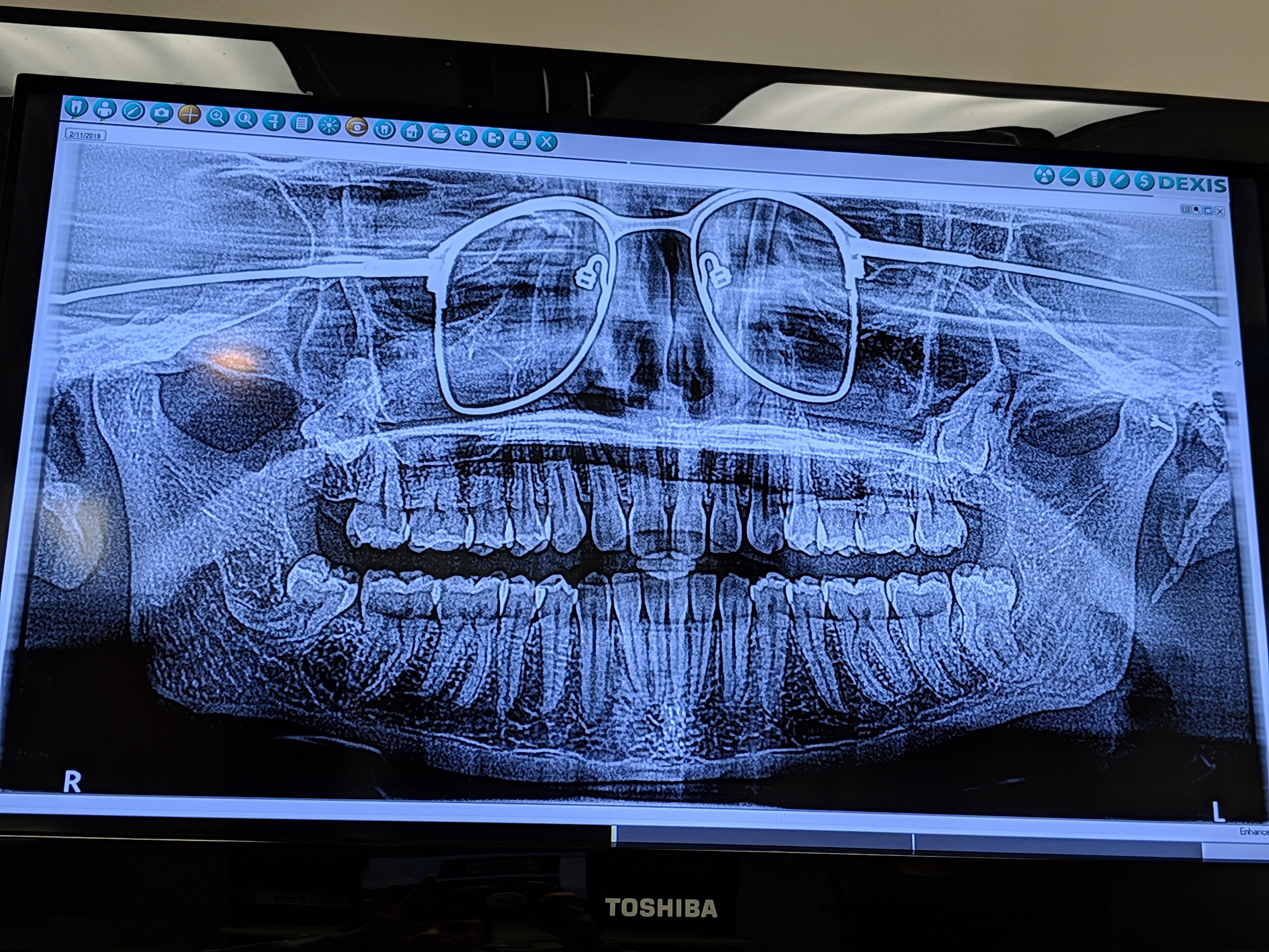 I got a panoramic xray of my teeth the other day. The dentist forgot to have me remove my glasses.