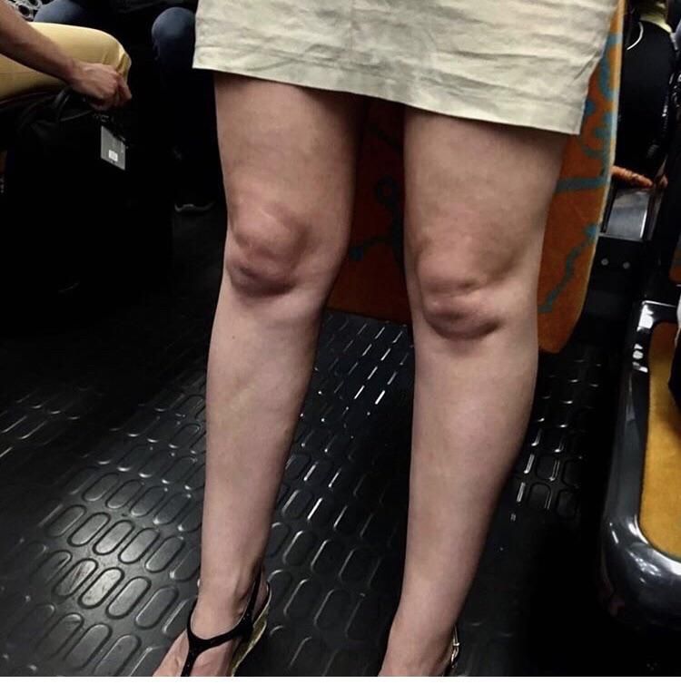 These knees look like two babies on a sonogram
