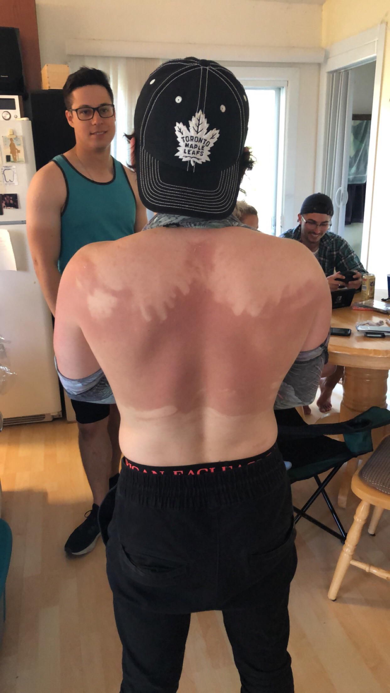 My friend refused to ask for help with putting sunscreen on, this is the result.
