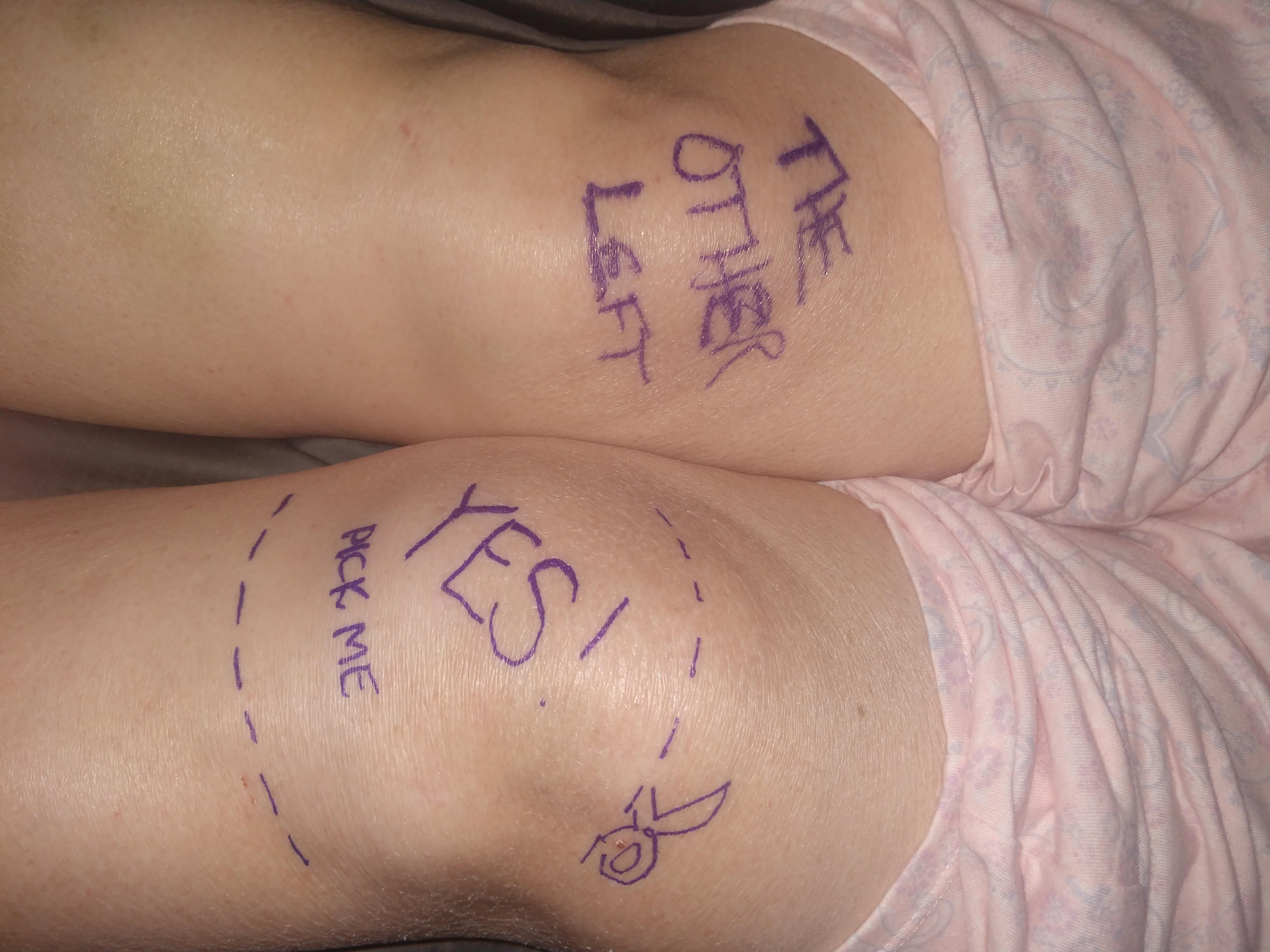 Doc told us to write yes on the knee to replace before surgery. We took it further.
