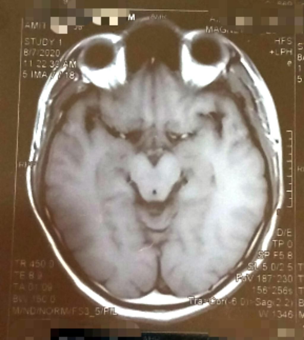 My brain MRI looks like the Grinch.