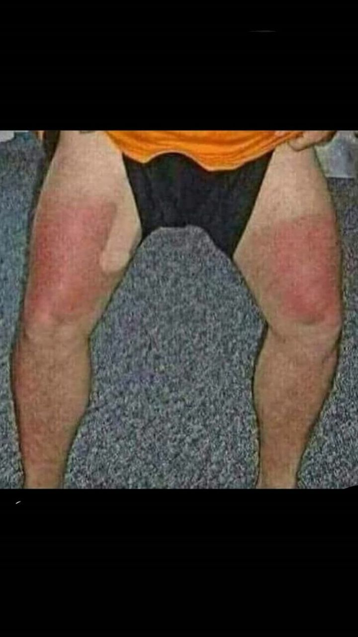 Guys look how bad I got sunburnt
