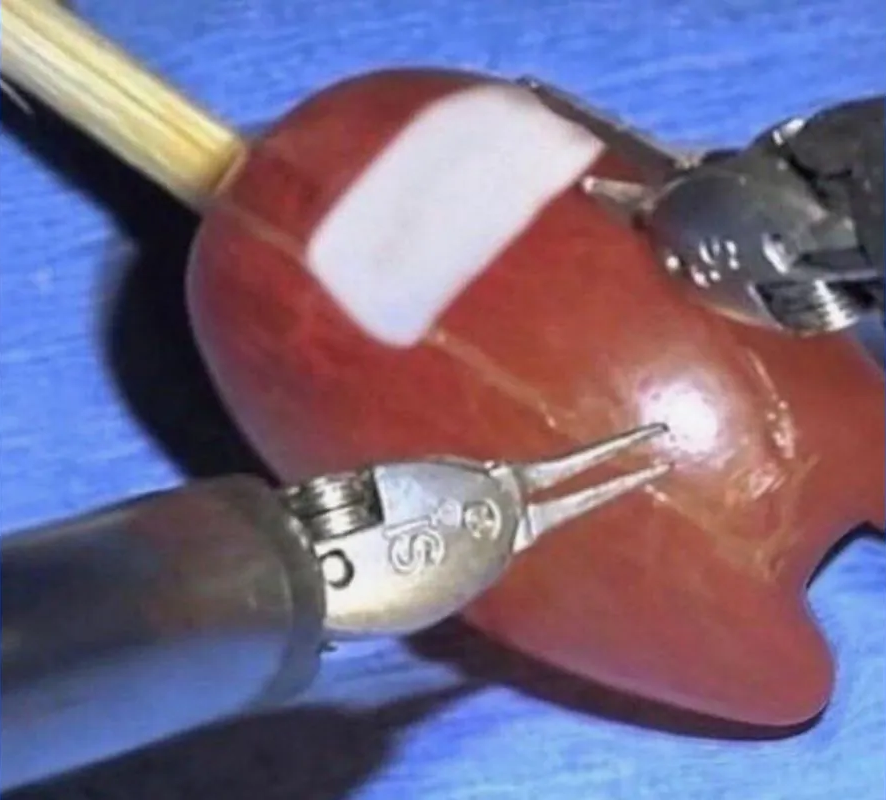 They did surgery on an imposter