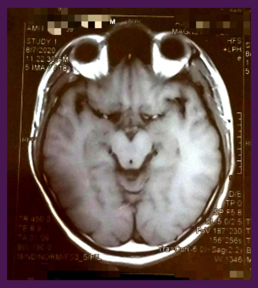 My cerebrum MRI resembles the Grinch.