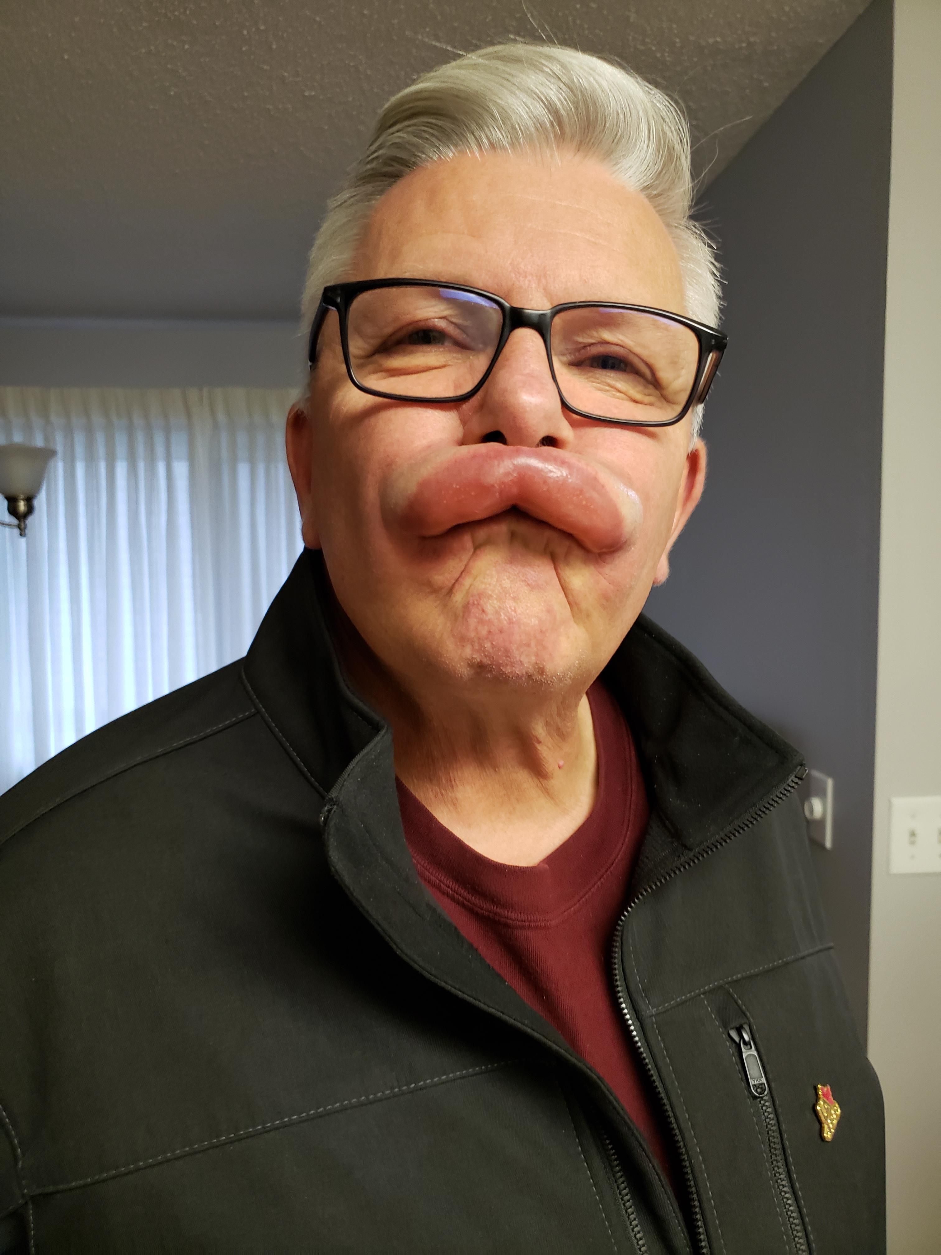 My dad had a small reaction after his root canal today.