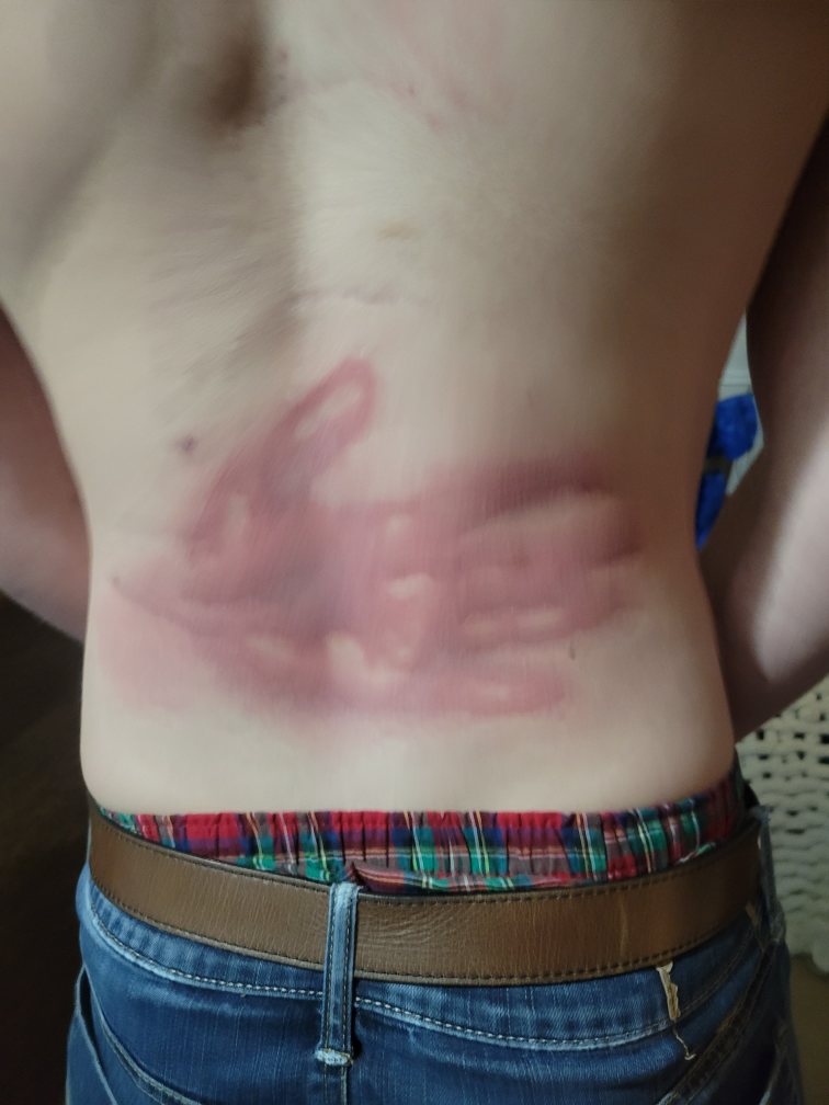 My friend got drunk and insisted on being slapped. This was the result