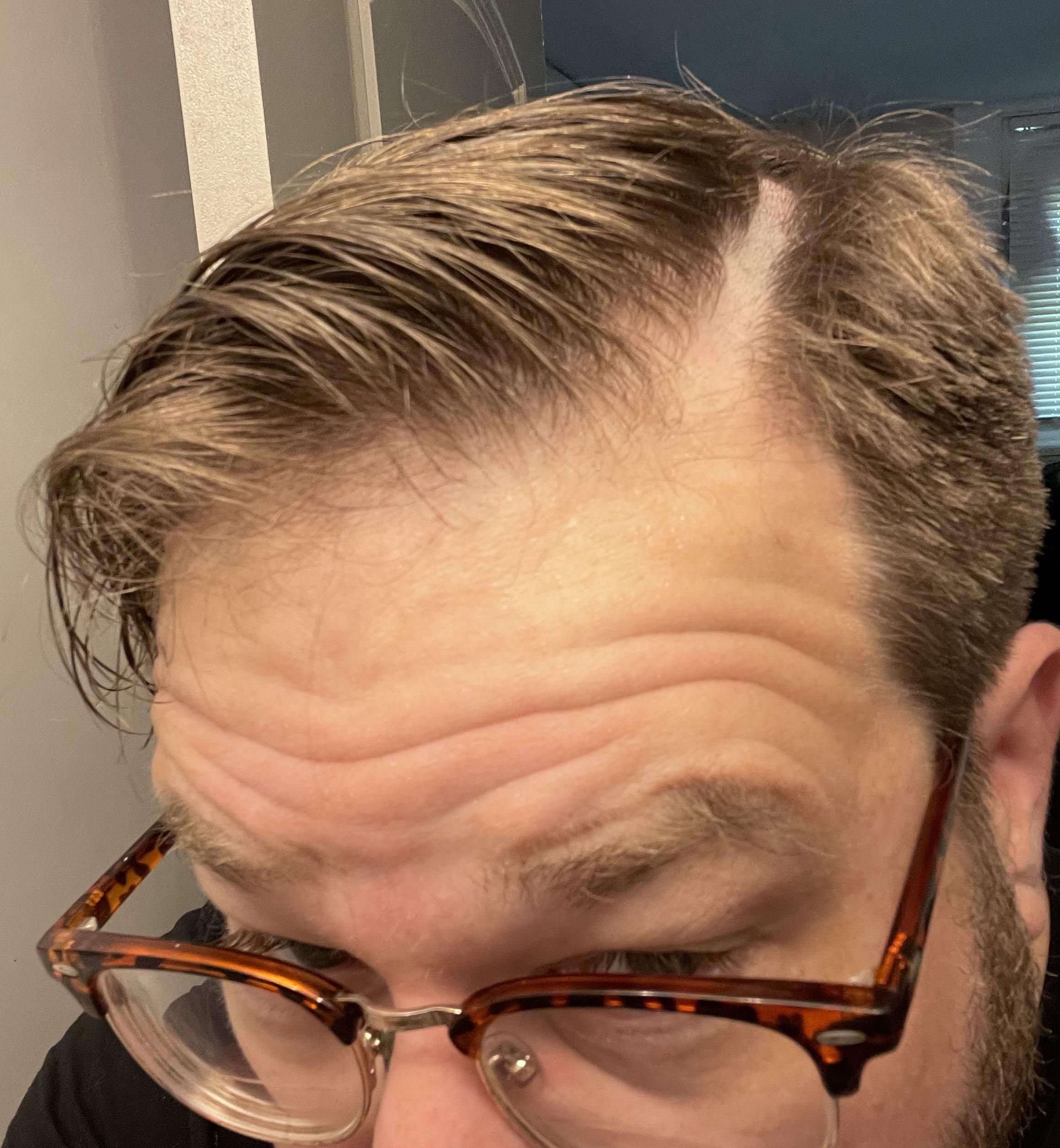 Went to a new barber. Asked for my part to be cut in. SHE MOWED A ***ING 1/2” STRIPE OUT OF MY HEAD!