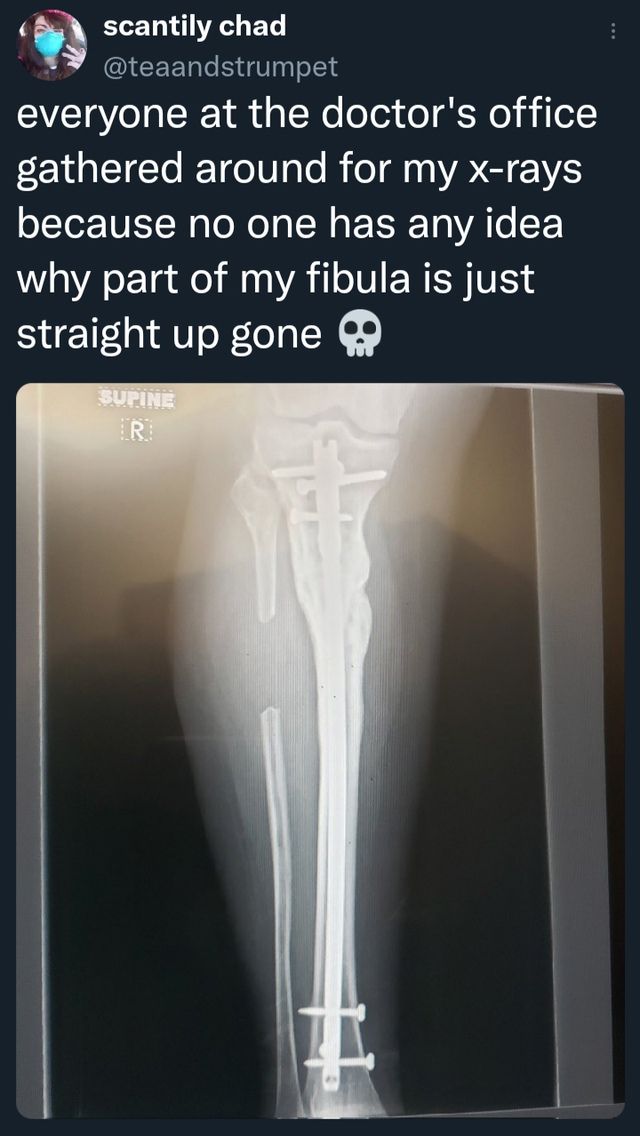 fibula
