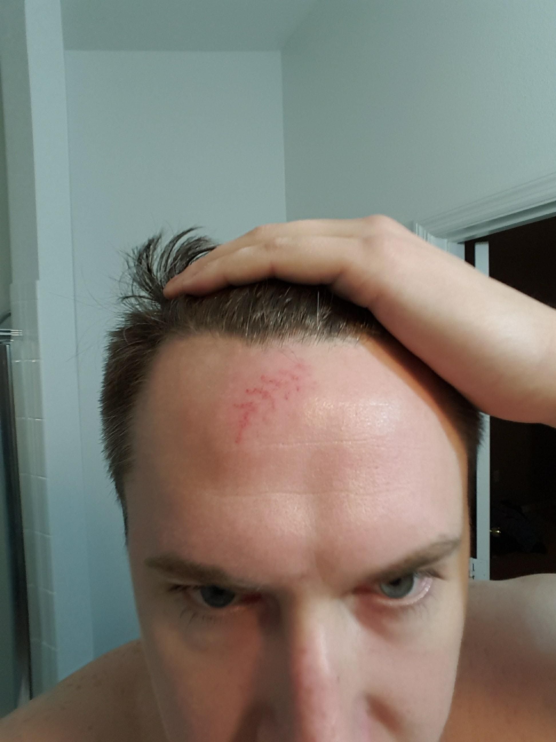 Joined a softball league, first game ever got hit in the forehead by the ball