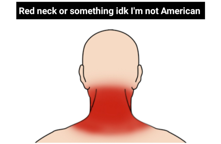 me after being in the sun for 5 minutes